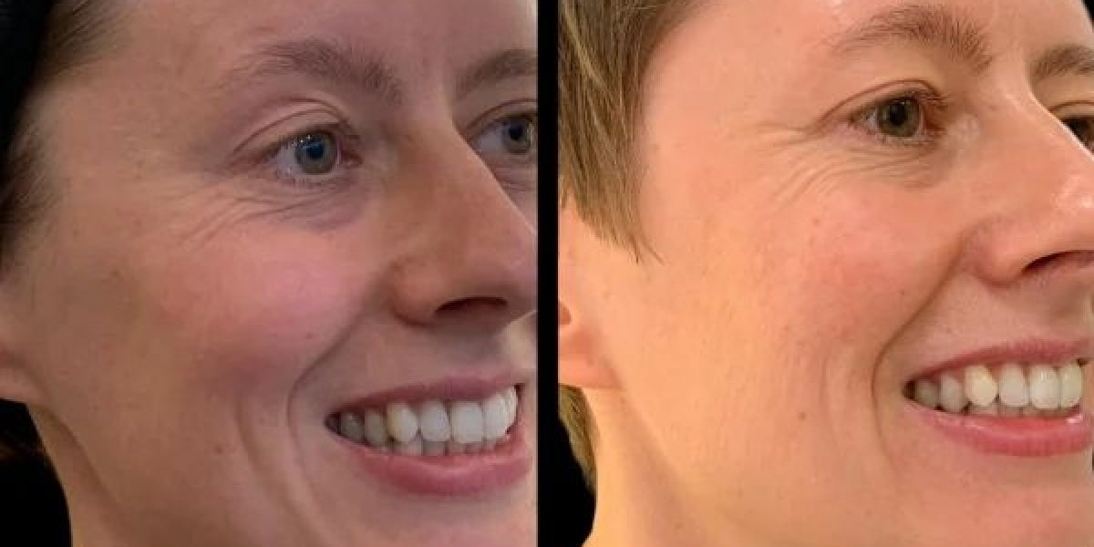 Best Aesthetic Clinics in Dubai for Safe Profhilo Sessions