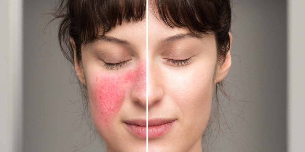 Rosacea In Manchester – Calm Redness and Soothe Irritated Skin