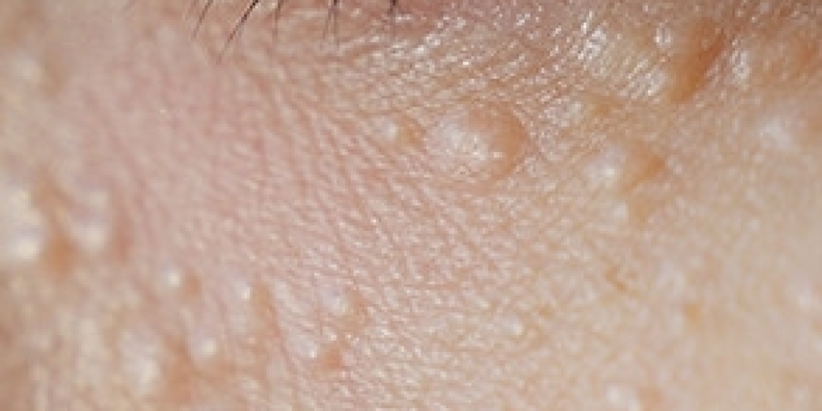 Deep Skin Renewal Wave Syringoma Removal Treatment for Pure Clarity Rise