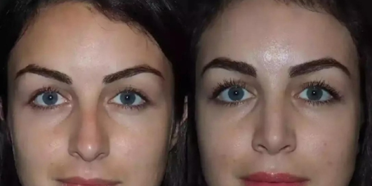 Best Doctors in Dubai for Rhinoplasty and the Evolution of Rhinoplasty Techniques