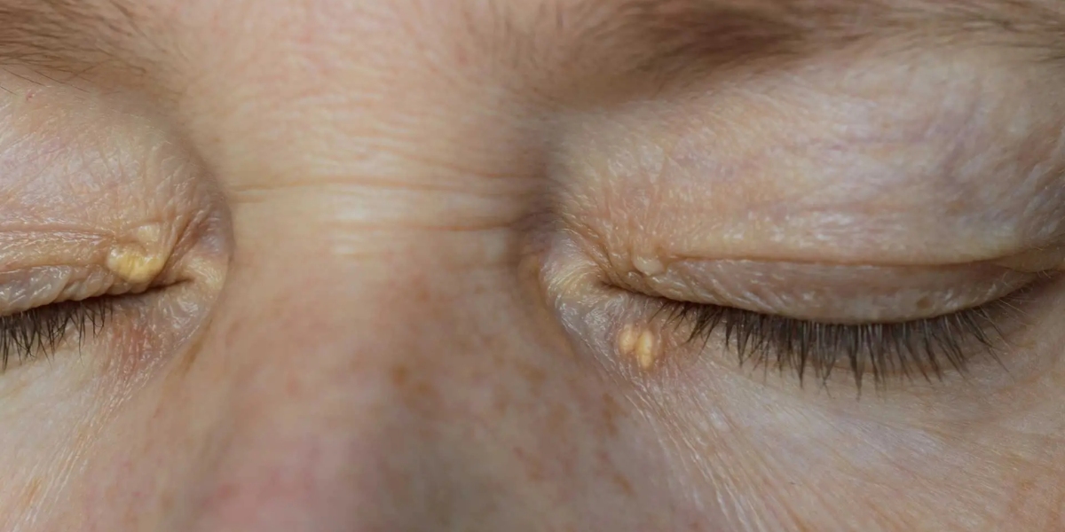 Eyelid Xanthelasma Removal: Can it refresh a youthful eye appearance?