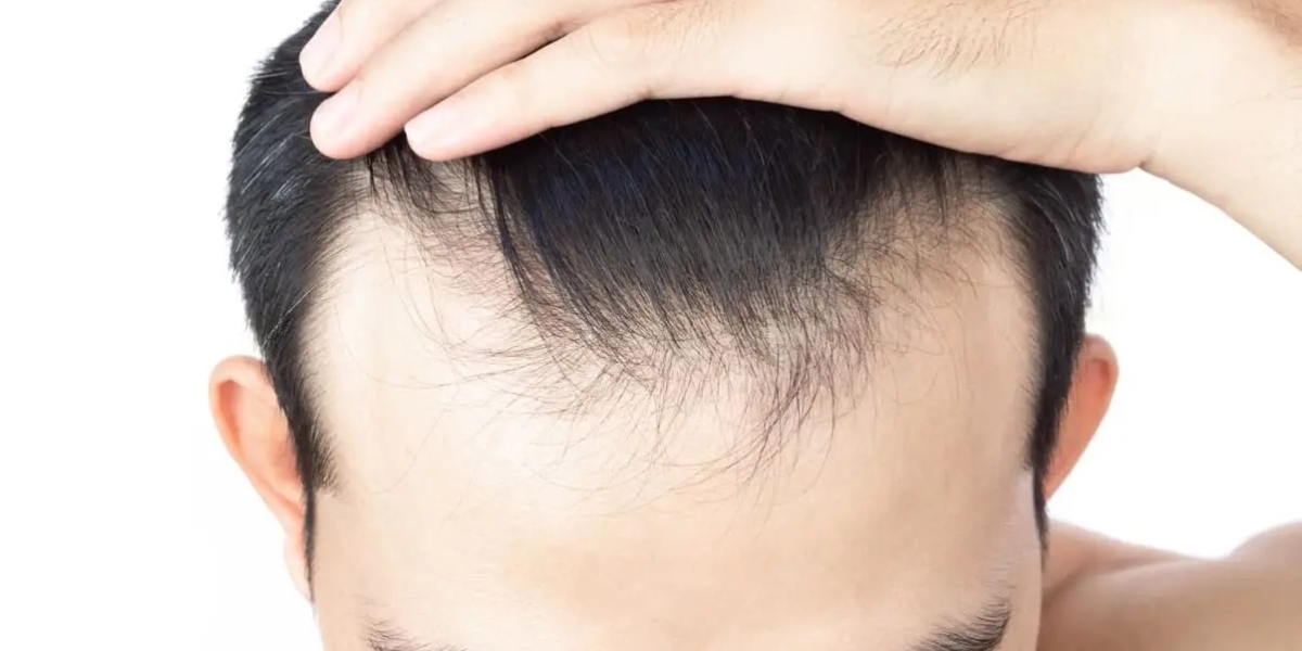 How Hair Transplant Costs Are Calculated by Dubai Clinics