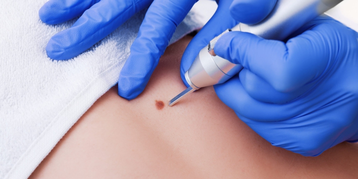 Can Mole Removal Enhance My Features?