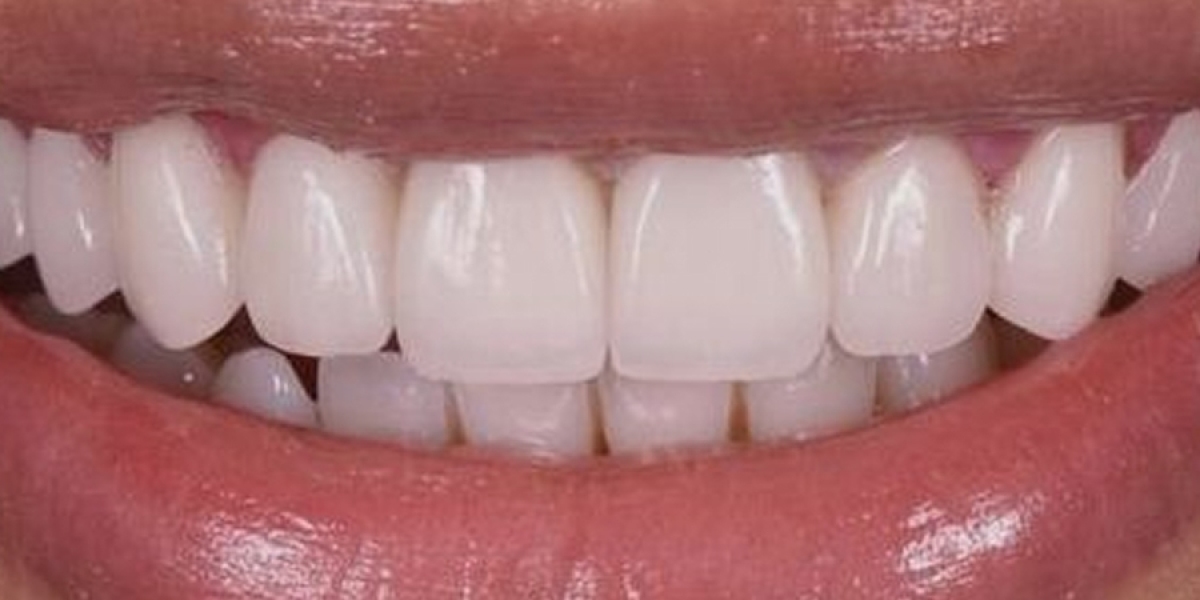 Unlock Bright Aura Instantly Using Teeth Whitening Magic