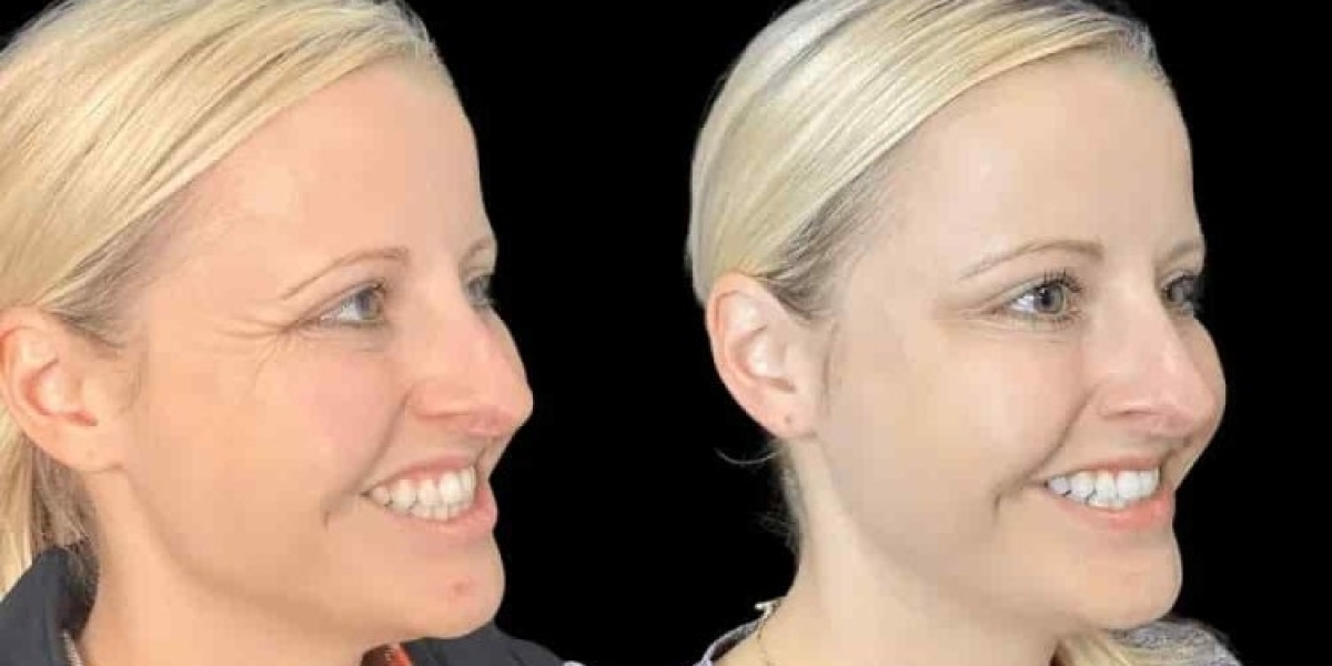 Best Doctors in Dubai for Botox for a Younger-Looking Appearance