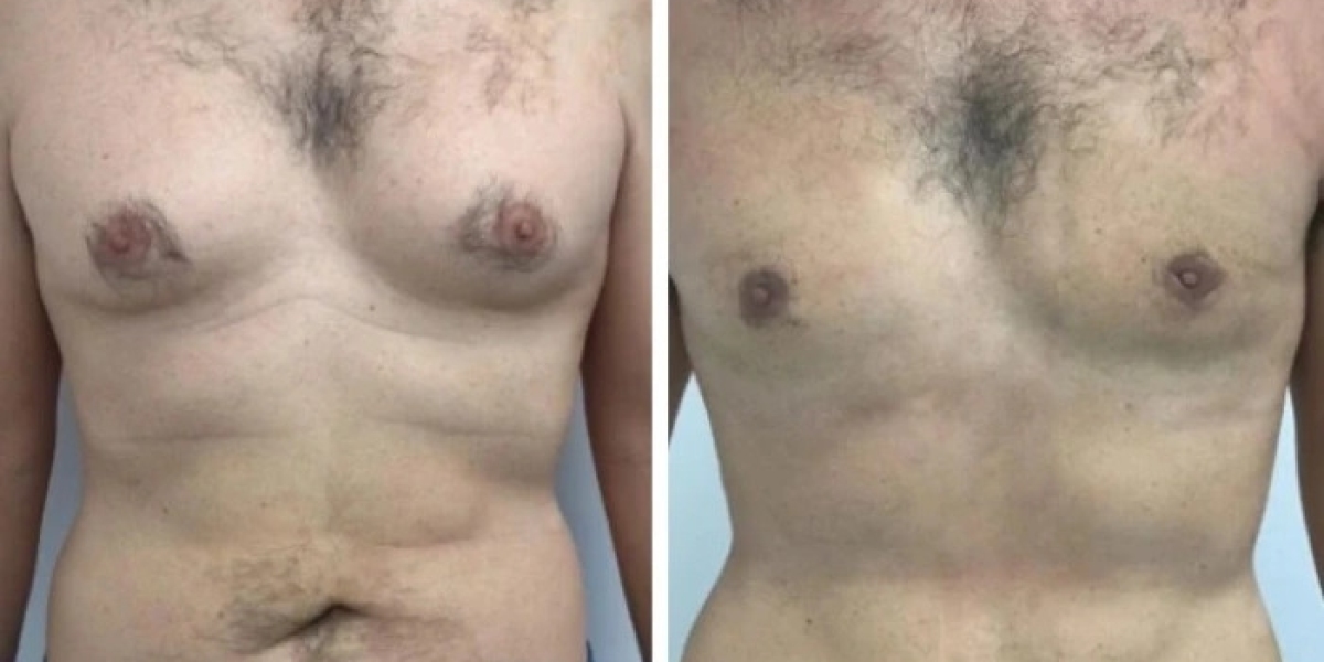 Trends Shaping the Future of Gynecomastia in Dubai Care