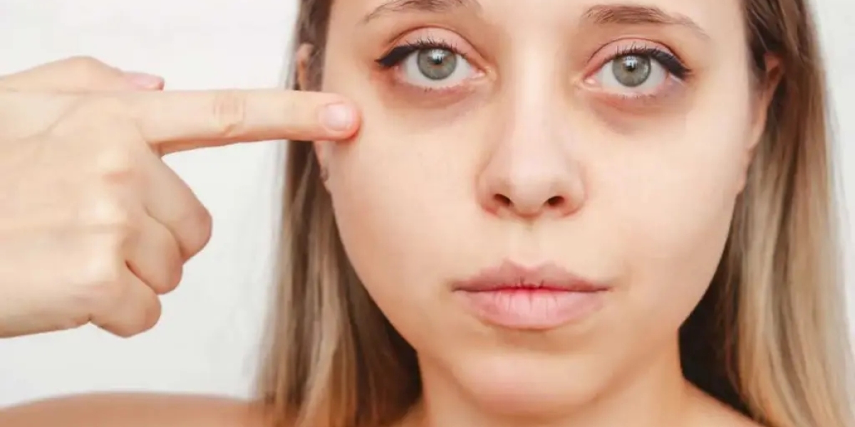 Eye Bag Removal: A Complete Informational Guide