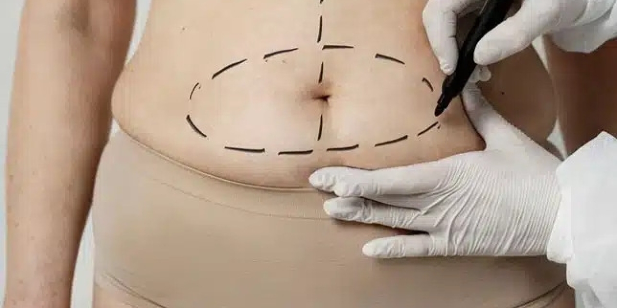 Can Men Benefit From Tummy Tuck in Dubai?