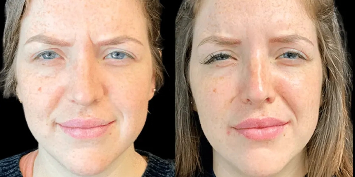 Botox in Dubai for Crow’s Feet: Benefits and Results