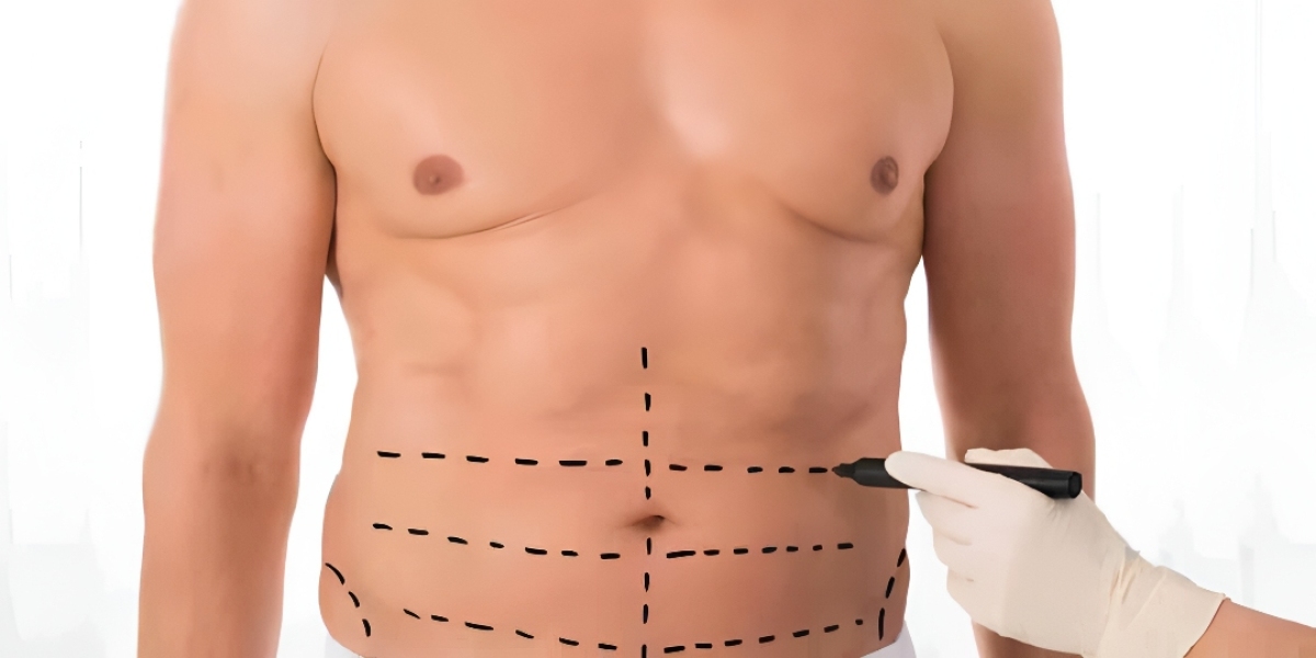 Why Patients Choose Liposuction in Islamabad