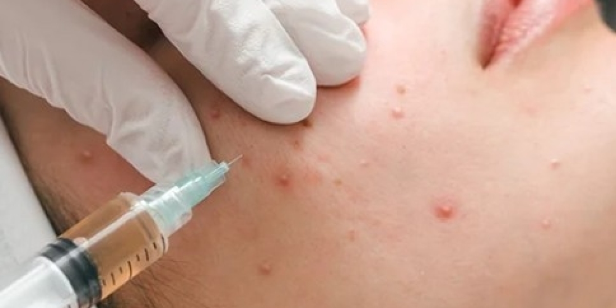 Acne Treatment In Dubai – Advanced Dermatology Solutions for Clear Skin