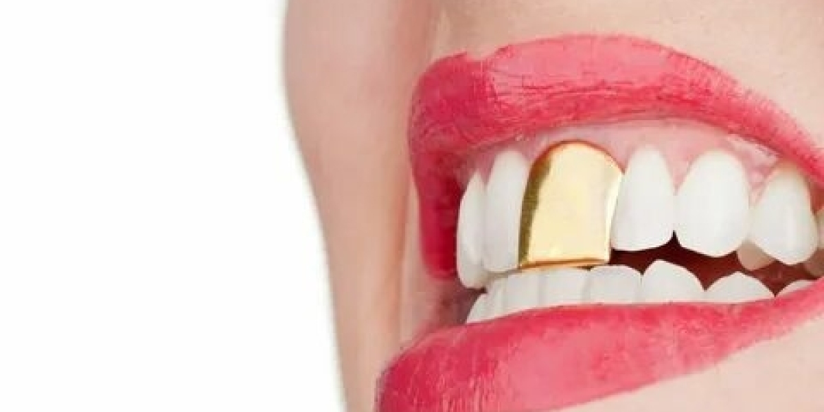 Are Gold Teeth the Secret to a More Distinctive Smile Today?