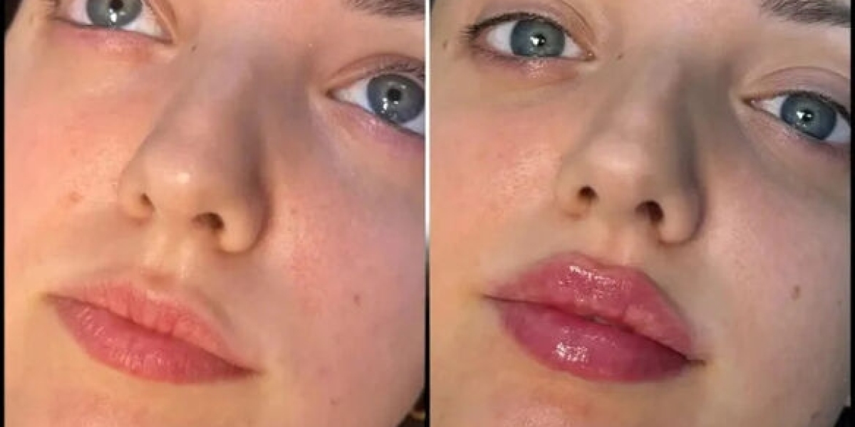 Best Doctors in Dubai for Fillers and Modern Anti-Aging Solutions