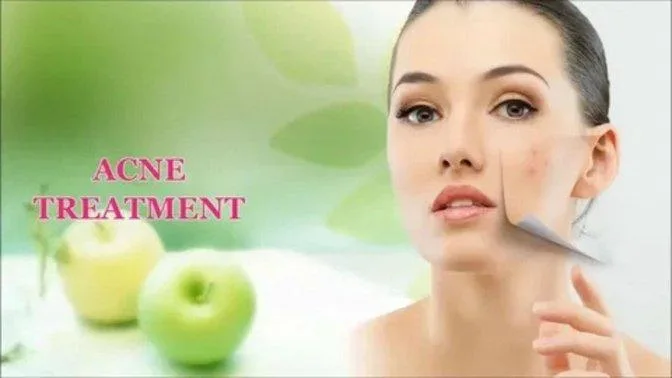 Acne Scars Treatment in Guwahati: Restore Smoother, Healthier Skin with Expert Care | Articles | sculpt India Clinic | Gan Jing World - Technology for Humanity | Video & Movie Streaming