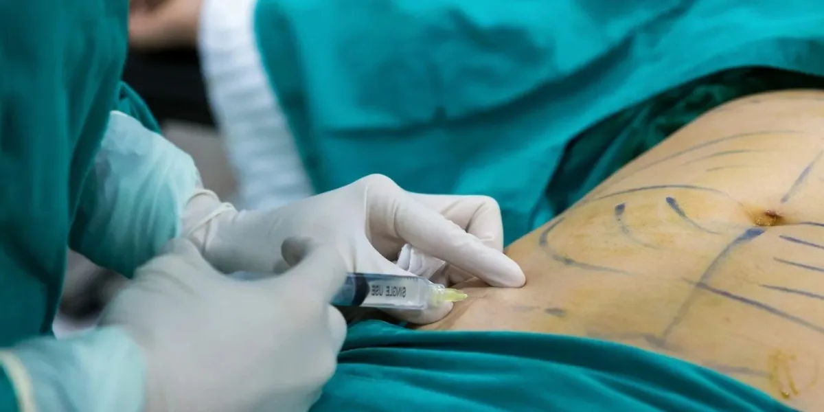 Factors That Affect the Cost of Liposuction in Islamabad