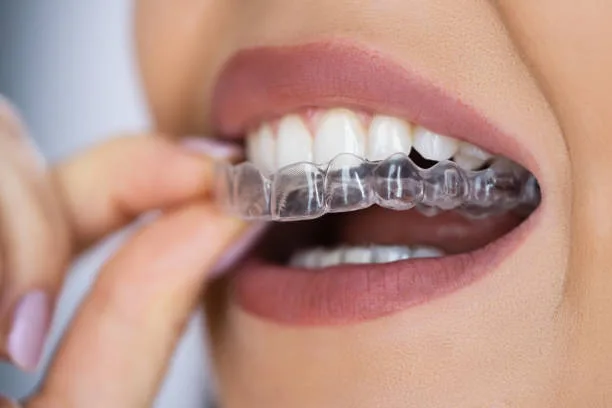 A Smarter Path to a Straighter Smile: What Modern Clear Aligners Offer | Orthodontics Center in West LA