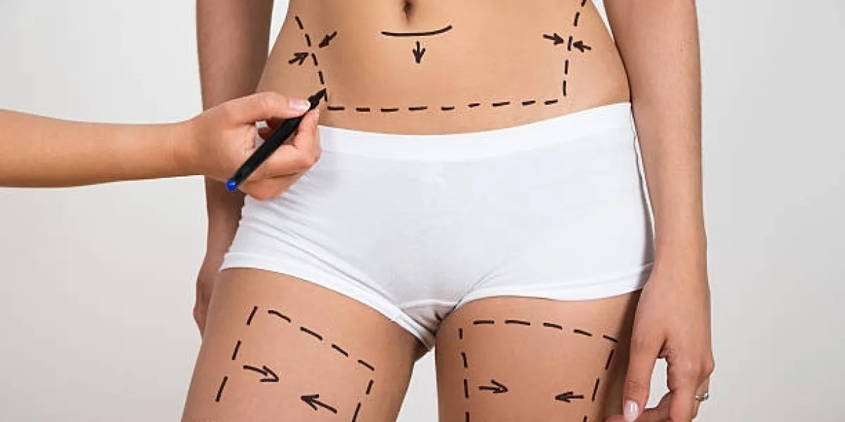 How to Maintain Your Body Contouring Results After Liposuction