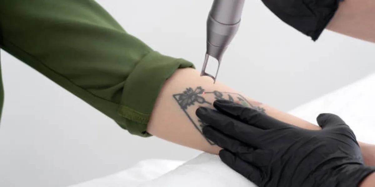 Understanding Temporary Skin Changes After Laser Tattoo Removal