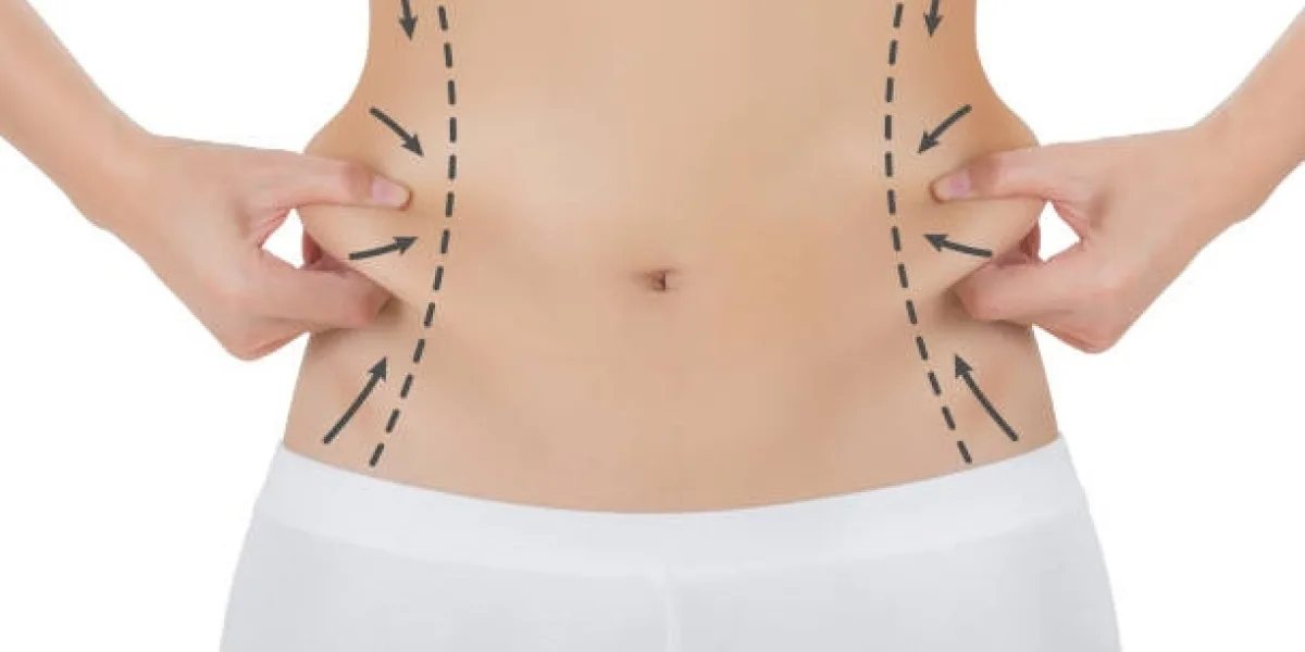How to Prepare for Liposuction in Riyadh