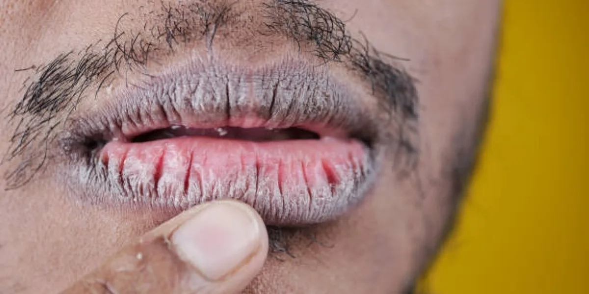 Treatments for Lip Discoloration Caused by Smoking