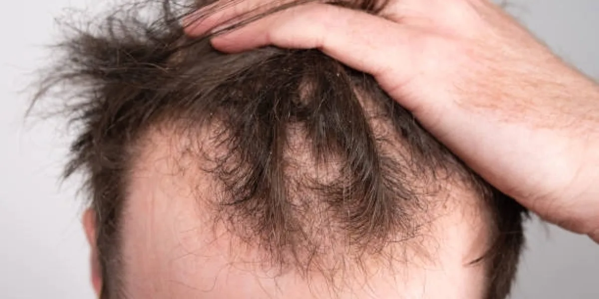 Hair Loss Treatment in Riyadh for Different Types of Hair Loss