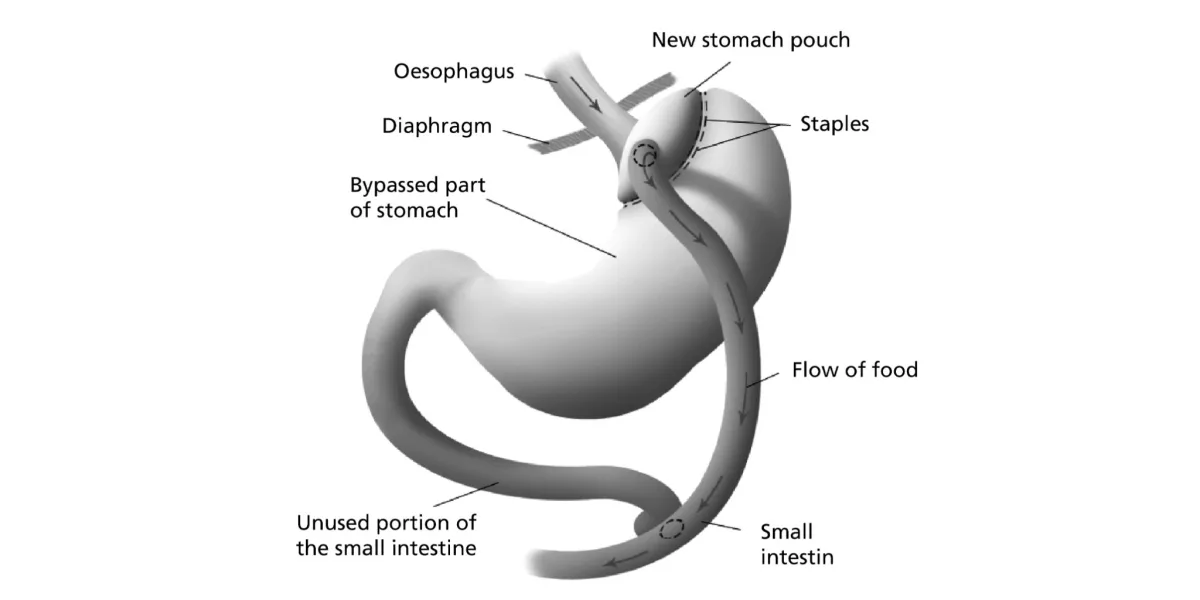 Roux en Y Gastric Bypass Surgery for Patients With Diabetes