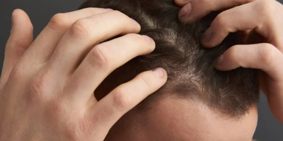 How to Choose a Clinic for PRP Hair Treatment in Riyadh