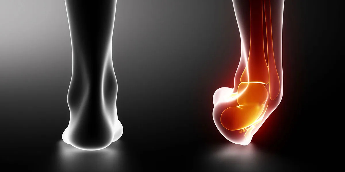 Ankle Sprain recovery with No.1 Physiotherapist in Noida