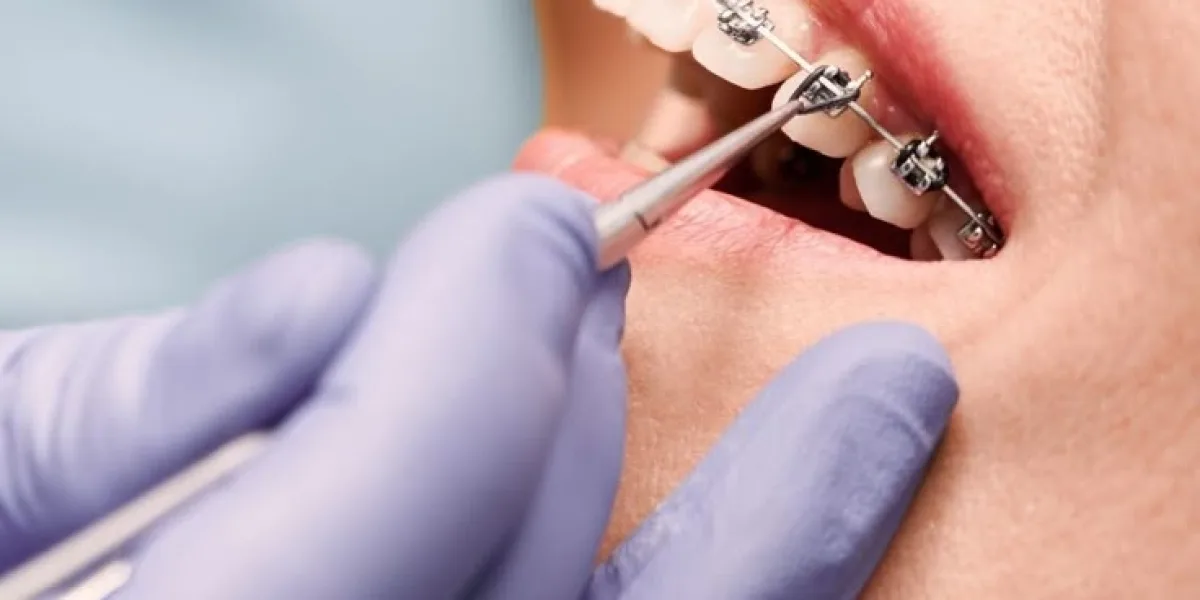 The Journey to a More Confident Smile Starts With Braces