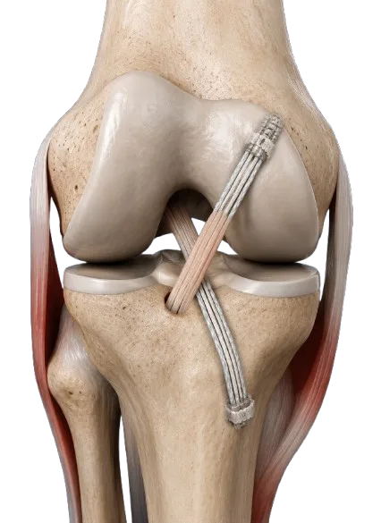 ACL Injury - Dr Dhruv Sharma