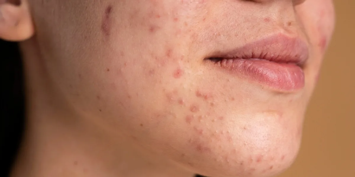 Acne Scar Treatment in Jayanagar: Complete Guide to Treatments, Cost & Recovery