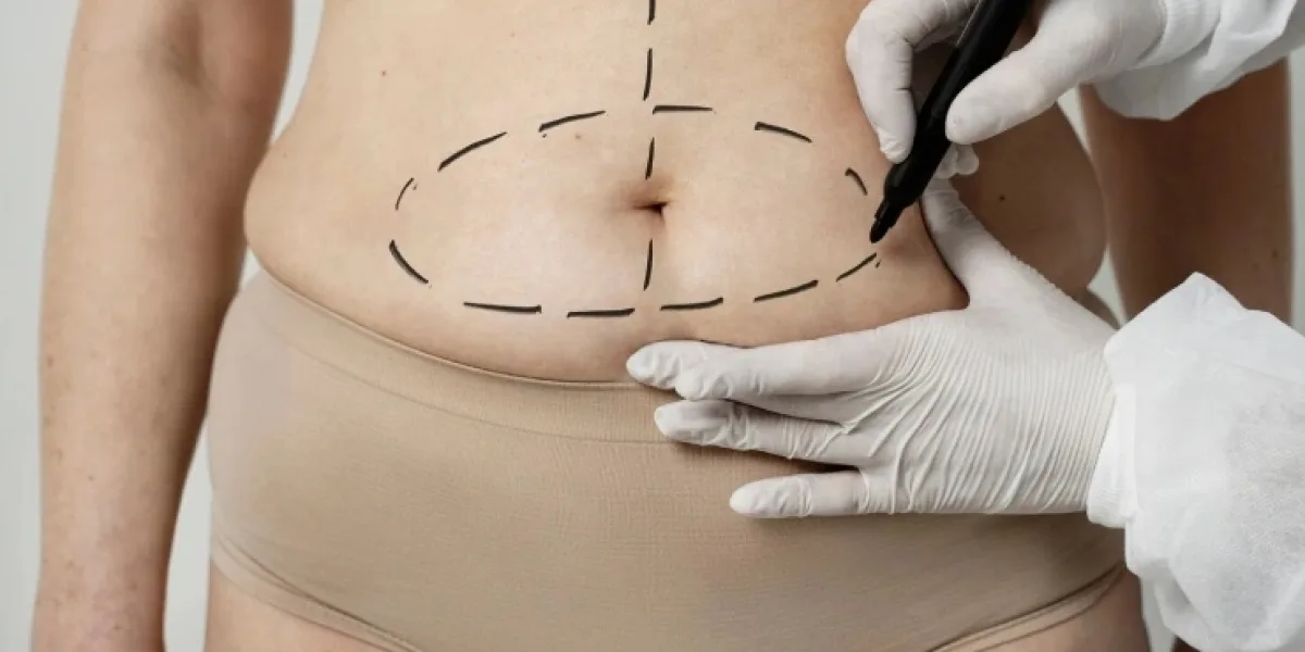 Tummy Tuck Surgery- For Which Conditions Is It Recommended?