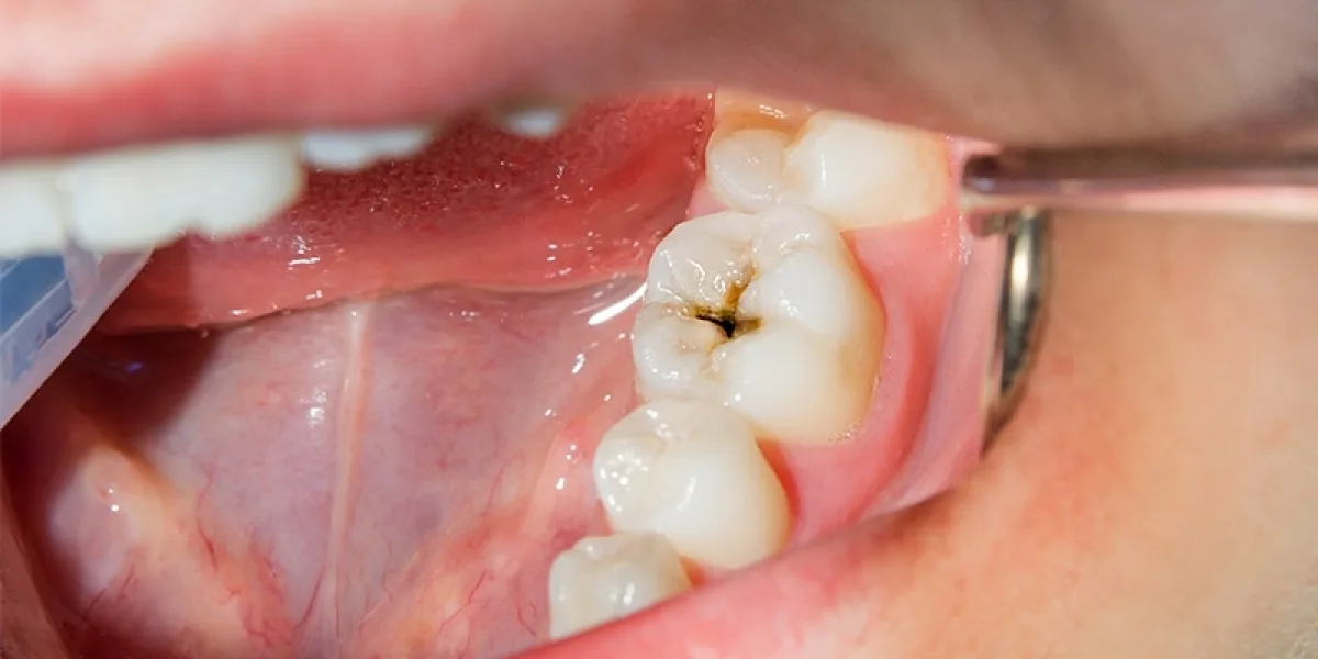 Best Dental Clinic in Pune for Teeth Cleaning and Scaling – Diagnopein Dental Care